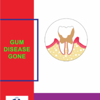 Gum Disease Gone